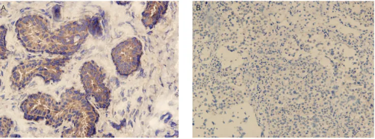 Figure 2 - The presence (a) and absence (b) of VEGF-C expression in breast cancer cells (Anti-VEGF-C antibody mouse isotype IgG2b,k, 200x).