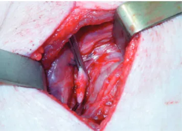 Figure 1 - Controlled section of the vessel wall in a lesion with a circumferential extent of 33%.