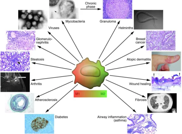 Figure  1.6.  Macrophage  plasticity  in  disease.  Macrophages  are  actively  involved  in  many  diseases  and  their  polarization changes from the M1 to the M2 phenotype with chronic inflammation