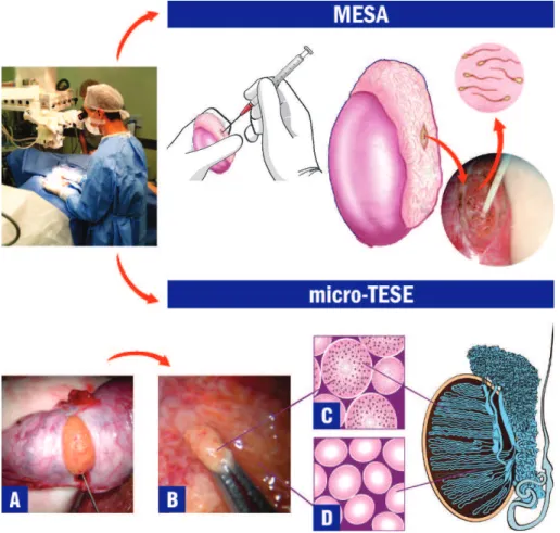 Table 1 - Treatment Results for Varicocele Repair in Infertile Men. Postoperative Recurrence, Hydrocele Formation and Spontaneous Pregnancy Rates using Various Techniques*.