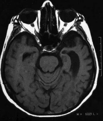 Figure 2 - SPECT (sequence of axial slices) showing left frontotemporal focal hypoperfusion.
