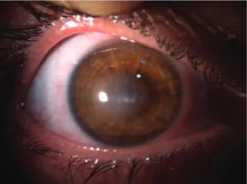 Figure 2 - The infection resolved, but residual central stromal opacification remained in the right eye.