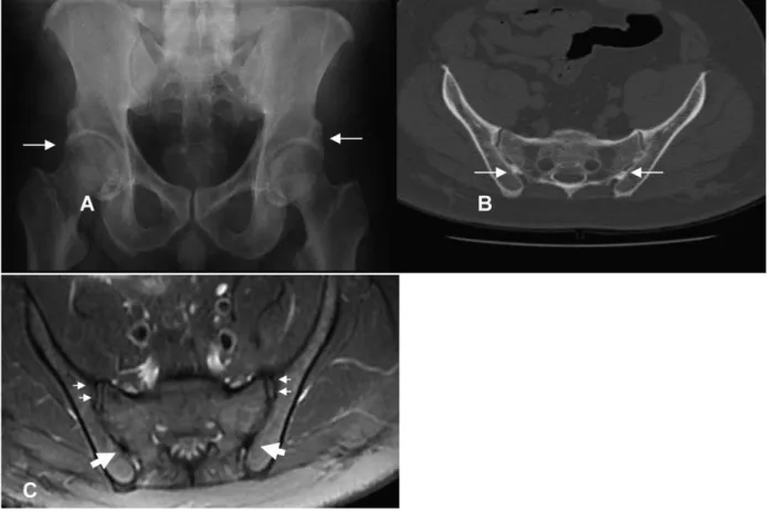 Figure 2 - A- Hip radiograph showing bilateral ossification at the superior acetabular margin (arrows)