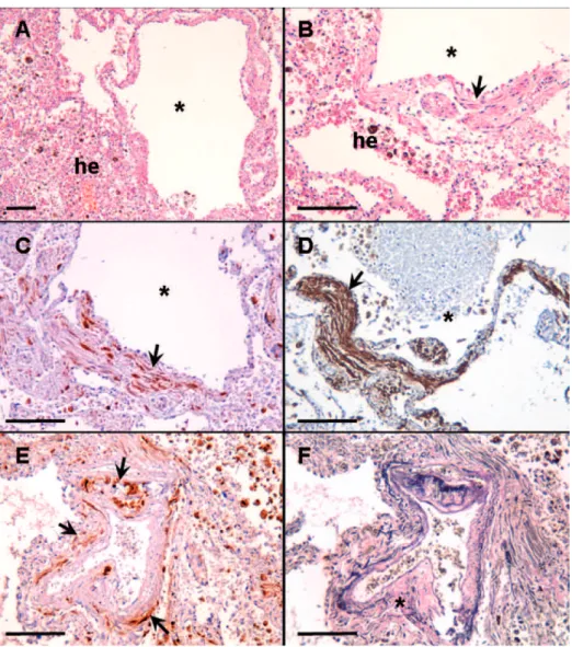 Figure 2 - Histological evaluation. Photomicrographs show pulmonary changes observed during the autopsy