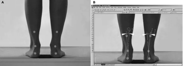 Figure 1 - Positioning of the markers (A) and quantification methods of rearfoot alignment (B).