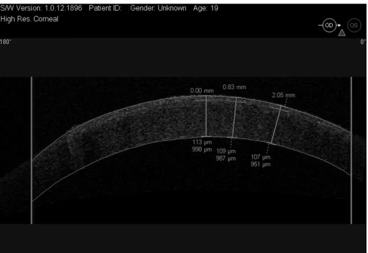 Figure 3 - OCT image of a thin flap created with the femtosecond laser.