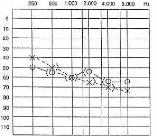 FIGURA 8 – Audiograma demonstrando perda auditiva do tipo neurossensorial (REDONDO; LOPES FILHO, 1996).