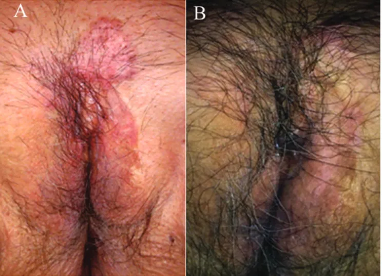 Figure 1 - Extramammary Paget’s disease. (A) Before treatment. Large hyperpigmented to pink plaque extending through the pubic area and left great labia