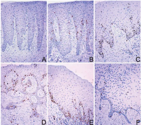 Figure 2 - Pattern of Mcm-2, Mcm-5 and geminin immunohistochemical staining in NG (top panel; A-C) and GF Family 3 (bottom panel;