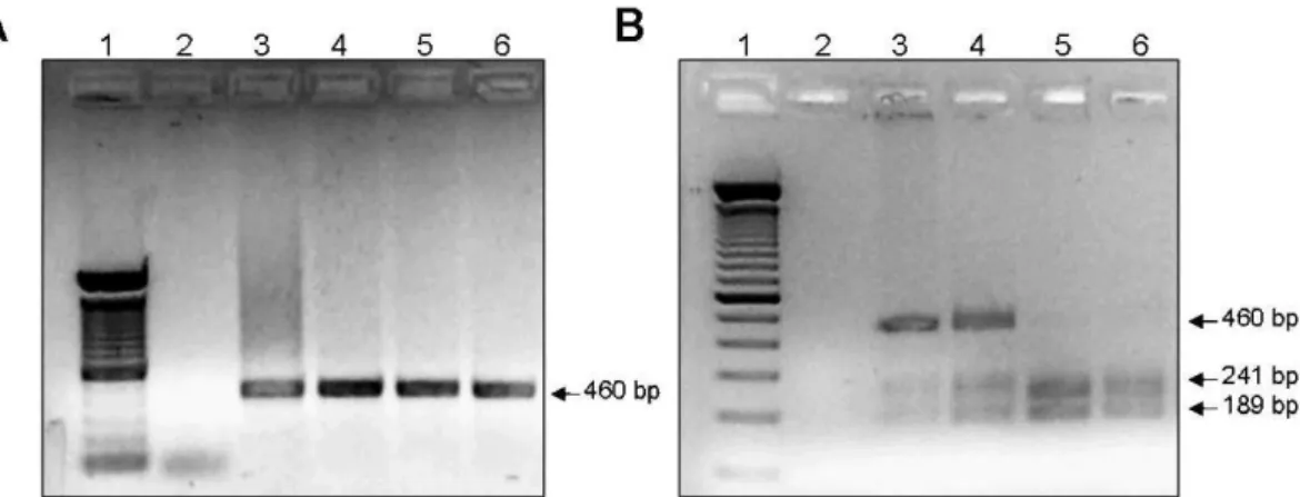 Figure 4 - FLT3 -D835 genotyping. (A) PCR amplification of FLT3 : lane 1: 100 bp ladder; lane 2: negative control; lanes 4 to 5: 114-bp amplicons obtained from the genomic DNA of patients with MDS (3-4) and AML (5)
