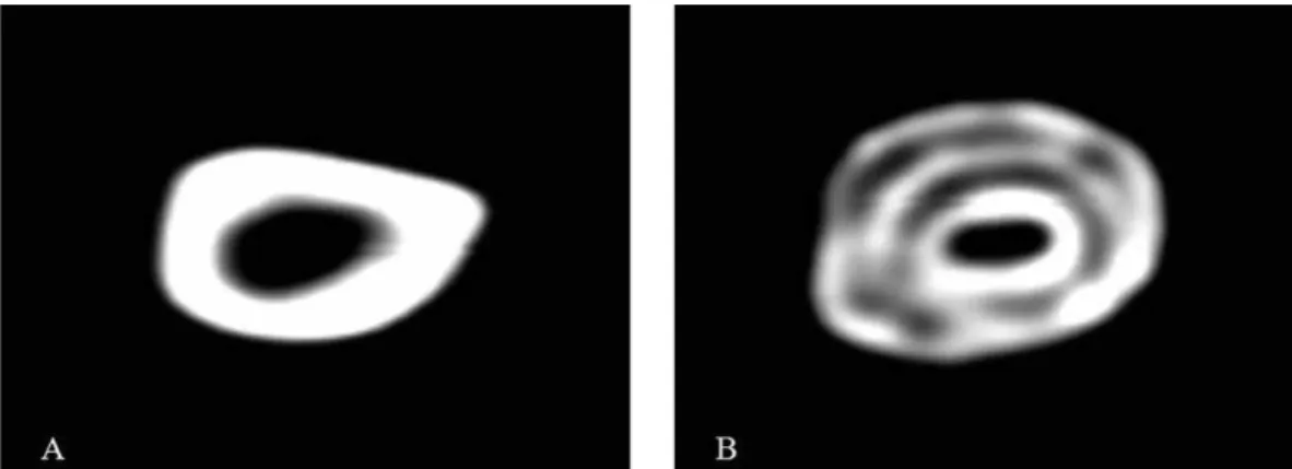 Figure 2 - A CT scan of an unfractured area of a femur (A) and a fractured callused area of the femur (B).
