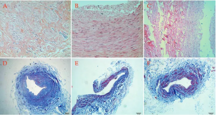 Figure 1 - Hematoxylin and eosin staining showing (A) proliferative medial smooth muscle cells with inflammatory cell infiltration in the saphenous veins, (B) focal intimal degeneration with slight disrupted media in the radial arteries, and (C) roughly no