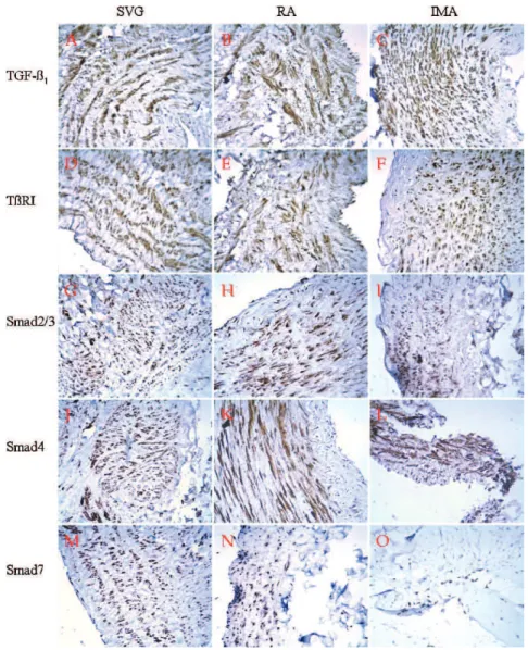 Figure 2 - Immunostaining showed that the five tested proteins (TGF-b 1 , TbRI, Smad2/3, Smad4, and Smad7) were positive, primarily in the cytoplasm of the medial layers, in all three kinds of grafts