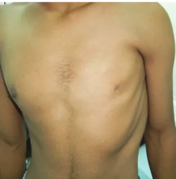 Figure 1 - The absence of the pectoralis muscles and nipple hypoplasia on the left side