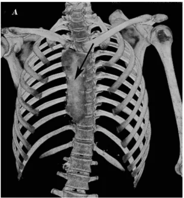 Figure 4 - An axial thracic CT scan reveals a defect in major and minor muscles of left pectoralis (white arrow).