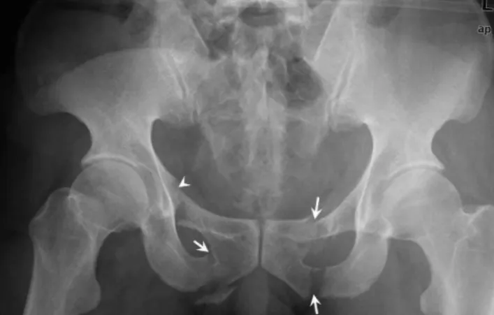 Table 1 - Tile Classification of pelvic ring fractures.