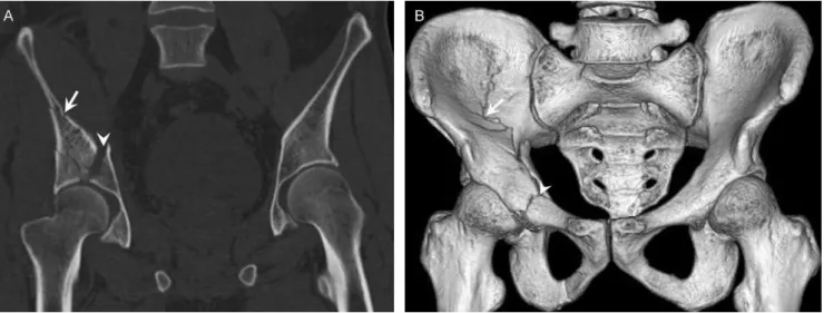 Table 2- Patients with pelvic fractures according to each pelvic bone involved.