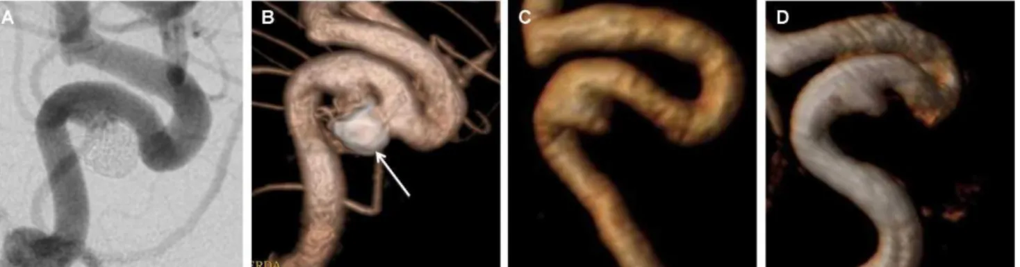 Table 1 - Aneurysm occlusion status as assessed by DSA and TOF-MRA, with Raymond’s classification, after interobserver consensus.