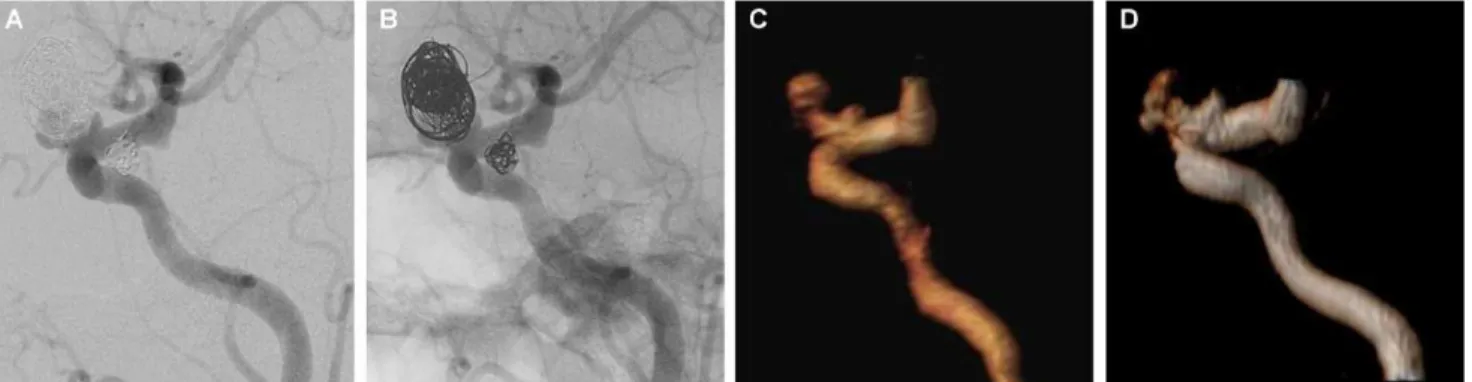 Figure 4 - Follow-up of an aneurysm treated with a stent remodeling technique (Neuroform 3), assessing the patency of the parent artery within the stent