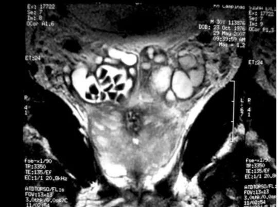Figure 3 - Magnetic resonance imaging showing enlarged seminal vesicles with lithiasis.