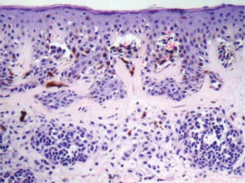 Figure 4 - Histopathologic exam of atypical nevus showing focal atypia of melanocytes, fusion of epithelial cones and concentric lamellar fibrosis