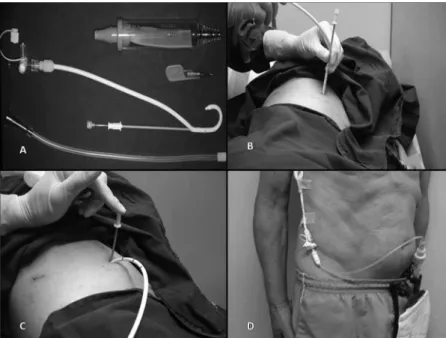 Figure 1 - (A) Pigtail catheter and Heimlich valve. (B and C) Catheter insertion using trocar technique, (D) Drain connected to the collection bag.