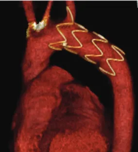 Figure 4 - Migration of the uncovered stent (free-flow end of endograft) into the left subclavian artery.