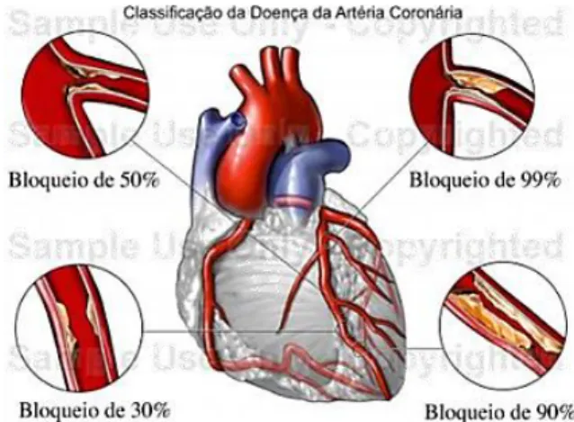 Figura 10 - Bloqueio das artérias coronárias