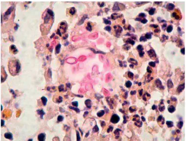 Figura  8:  Corte  histológico  corado  pelo  mucicarmim  evidenciando  blastoconídeo com cápsula radiada (40x)