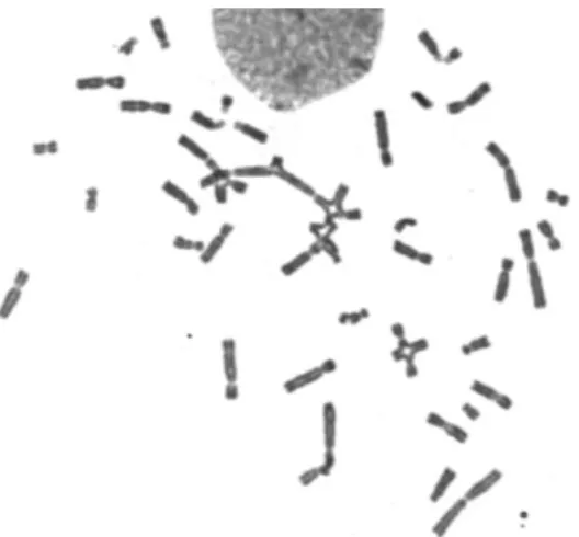Figure 1: Diepoxybutane (DEB)-induced chromosome instability (CI) in Fanconi anemia(FA) patient