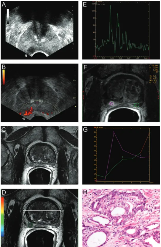 Figure 1 - 64-year-old man with prostate cancer (prostate specific antigen (PSA) level 5.2 ng/ml)