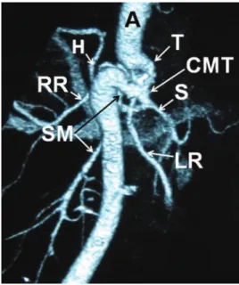 Figure 1 - 3D computed tomography (CT) angiography. A = aorta; T = tortuousity; H = common hepatic artery; S = splenic artery; CMT = common celiacomesenteric trunk; SM = superior mesenteric artery; RR = right renal artery; LR = left renal artery.