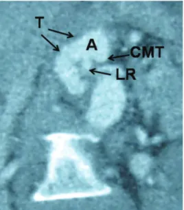 Figure 2 - Reconstructed coronal computed tomography (CT) image. A = aorta; T = tortuousity; CMT = common  celiacome-senteric trunk; LR = left renal artery.