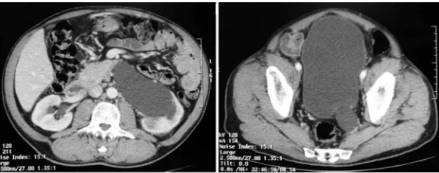 Figure 1 - Computer tomography showing (A) dilated left upper urinary tract and (B) left megaureter close to the bladder.
