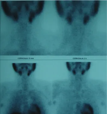 Figure 7 - Numbers (%) of patients with hyperparathyroidism/