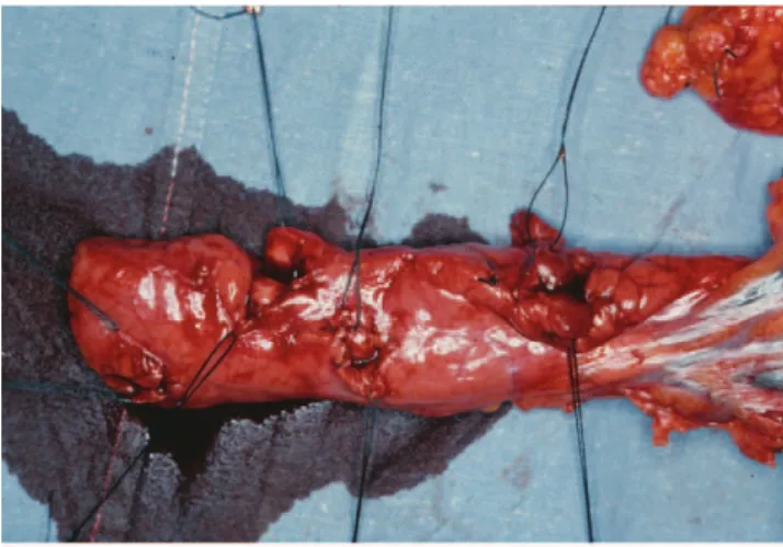 Figure 3 - Distal pancreatectomy in a patient with insulinomas associated with multiple endocrine neoplasia type 1