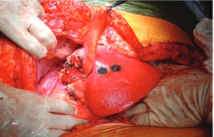 Figure 4 - Patient with bilateral liver metastases. After portal vein embolization of the right liver, an extended right hepatectomy was performed with enucleation of the left lobe metastases.