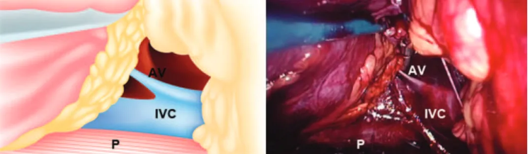 Figure 4 - Left-side retroperitoneoscopic view. A: adrenal. AV: adrenal vein. LV: lumbar vein