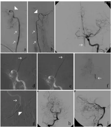 Figure 3 - (a, b) a DSA of (a)the right vertebral artery (RVA) and (b) the left vertebral artery (LVA) (white arrows), arterial phase, frontal views, shows an occlusion of the proximal basilar artery (BA) (white arrowheads); (c) a DSA of the LCCA (frontal 