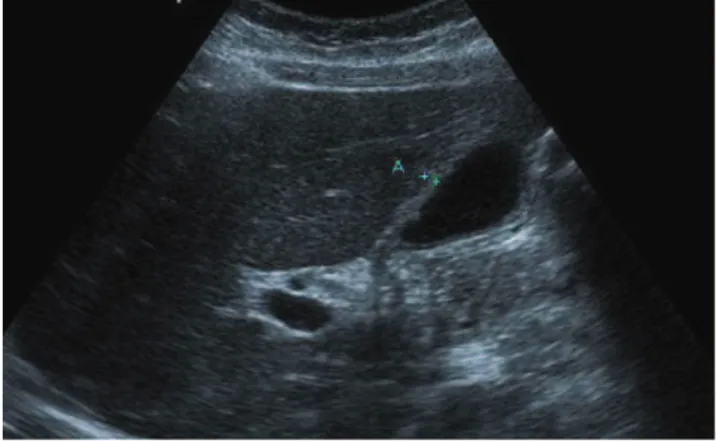 Figure 3 - The focal area of pyelonephritis in the left kidney on color Doppler imaging.