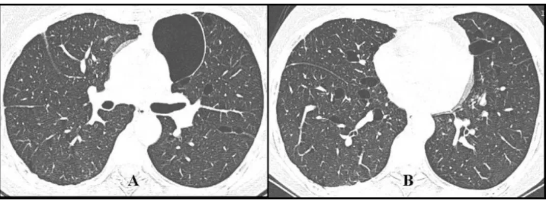 Figure 1 - High-resolution chest CT. A) A CT scan showing thin-walled, air-filled cystic lesions, including one dominant cyst (6 6 5 cm).