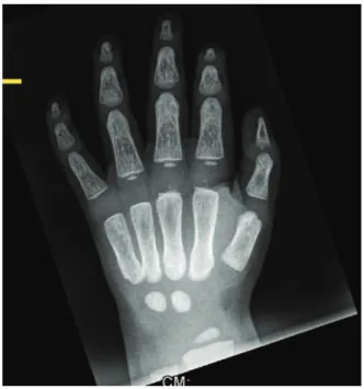 Figure 4 - Axial CT scanning shows progressive and bilateral narrowing of the optic canal.