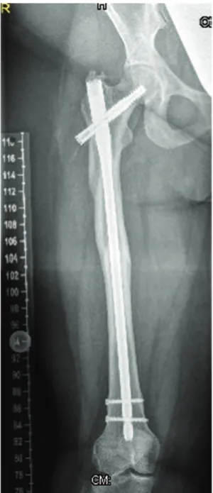 Figure 5 - Anteroposterior lower extremity (retrospective) radio- radio-graphs show mild diaphyseal hyperostosis associated with  mid-diaphyseal fractures and locked intramedullary nailing.