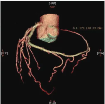 Figure 1 - In the CT image, the LCx was the dominant vessel. It appeared to continue beyond the atrioventricular groove up to the level normally occupied by the RCA.