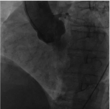 Figure 4 - During surgery, the right coronary artery ostium was not observed.