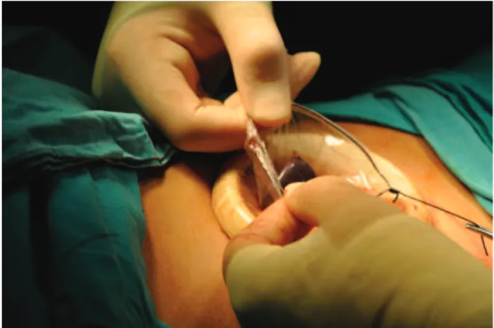 Figure 3 - Cutting the hilum of the spleen using an Endo-GIA II stapler.