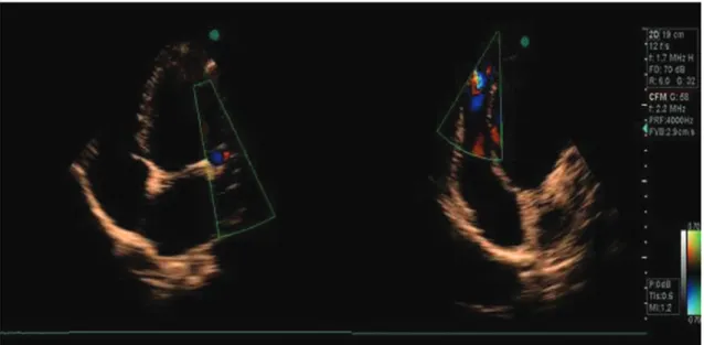 Figure 2 - Coronary angiography revealing a markedly dilated tortuous circumflex coronary artery connected to the right ventricle, indicating a coronary artery fistula.