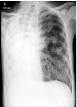 Figure 1 - Chest X-ray showing a diffuse opacity of the right lung that is compatible with atelectasis.