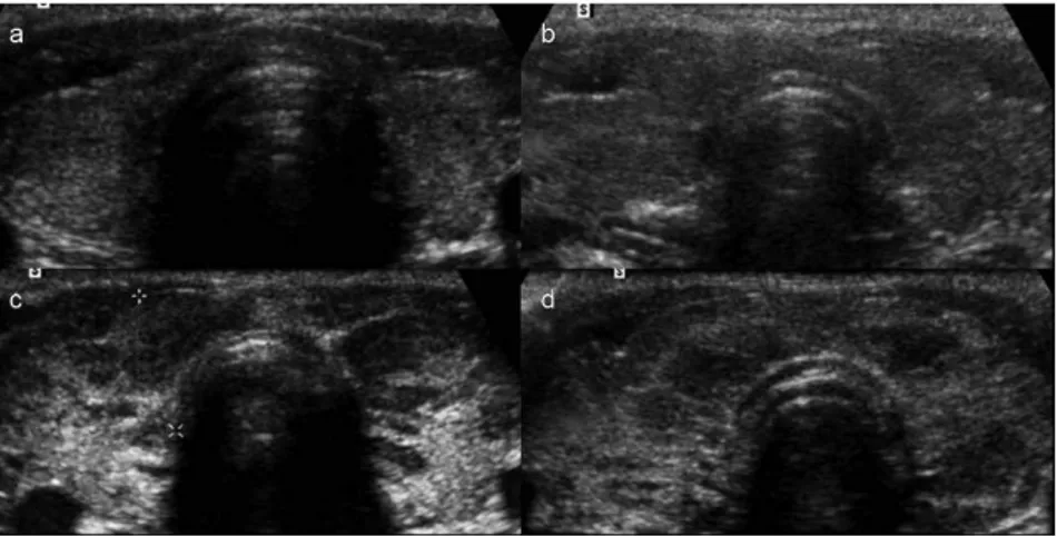 Figure 2 - Color Doppler patterns. a. Pattern 0 (normal thyroid vascularity); b. color Doppler Pattern I (minimally increased thyroid vascularity); c