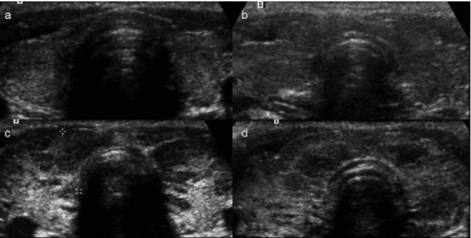 Figure 2 - Color Doppler patterns. a. Pattern 0 (normal thyroid vascularity); b. color Doppler Pattern I (minimally increased thyroid vascularity); c
